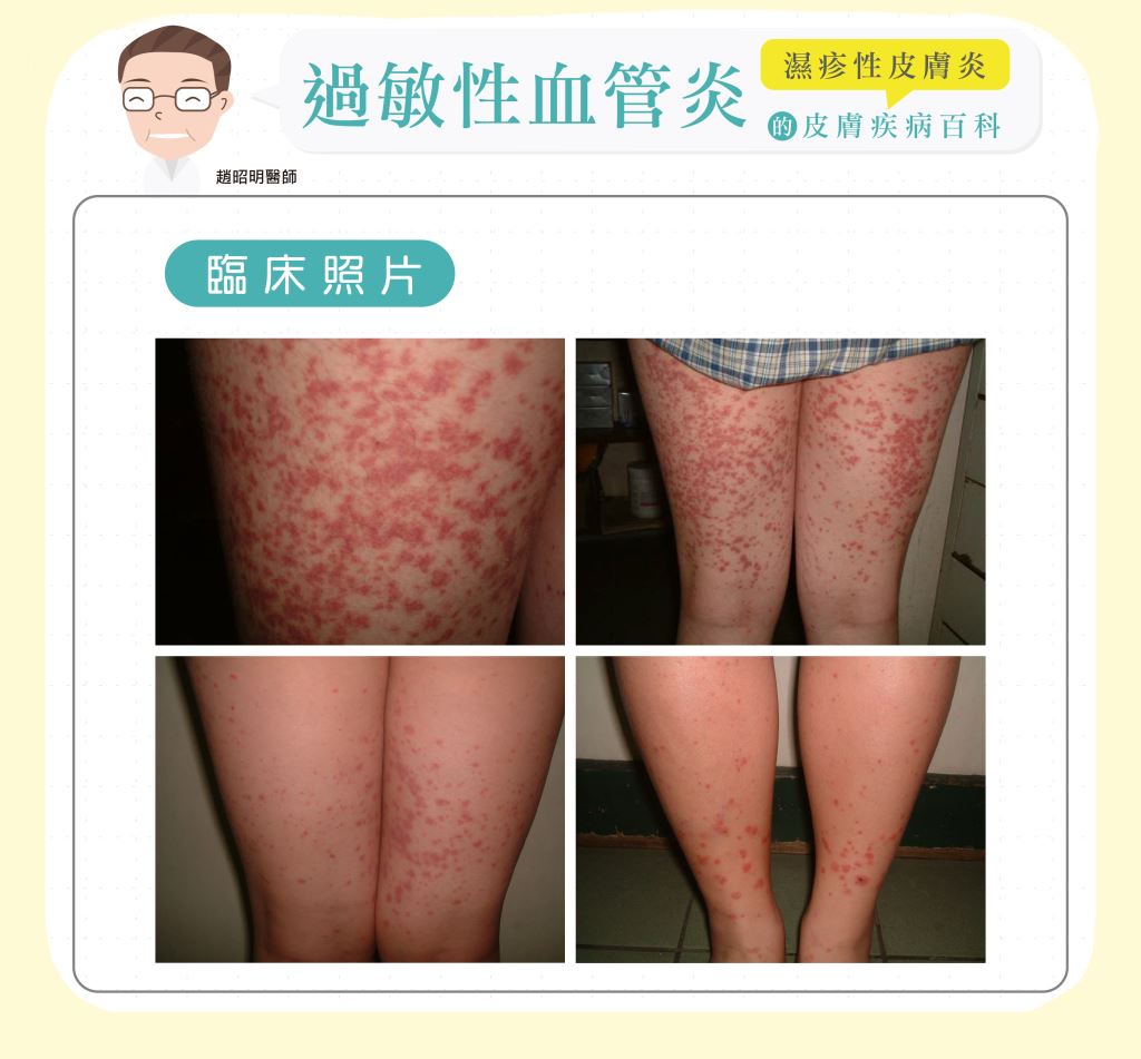 過敏性血管炎Allergic vasculitis